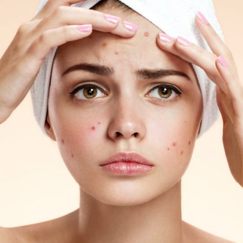 Acne Treatment, Large Pores or Scars